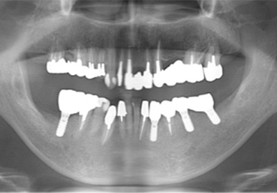 インプラント治療後