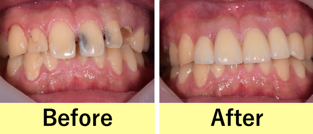 【症例】前歯の大きな虫歯をジルコニアセラミックを用いて審美治療