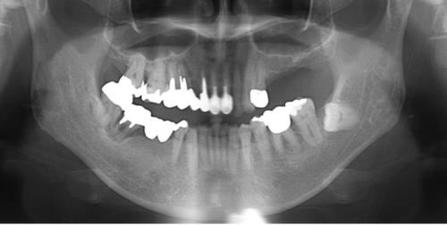 横浜市桜木町の歯医者「みらい歯科」症例｜【症例】インプラントによる治療で、奥歯でしっかり噛めるように｜図1＿レントゲン