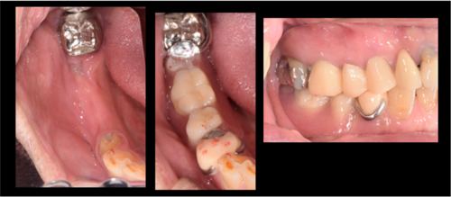 横浜市桜木町の歯医者「みらい歯科」症例｜【症例】インプラントによる治療で、奥歯でしっかり噛めるように｜図2_口腔内