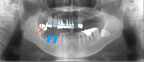 横浜市桜木町の歯医者「みらい歯科」症例｜【症例】インプラントによる治療で、奥歯でしっかり噛めるように｜図4_レントゲン