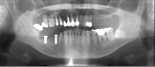 横浜市桜木町の歯医者「みらい歯科」症例｜【症例】インプラントによる治療で、奥歯でしっかり噛めるように｜図5_レントゲン