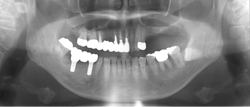 横浜市桜木町の歯医者「みらい歯科」症例｜【症例】インプラントによる治療で、奥歯でしっかり噛めるように｜図6_レントゲン