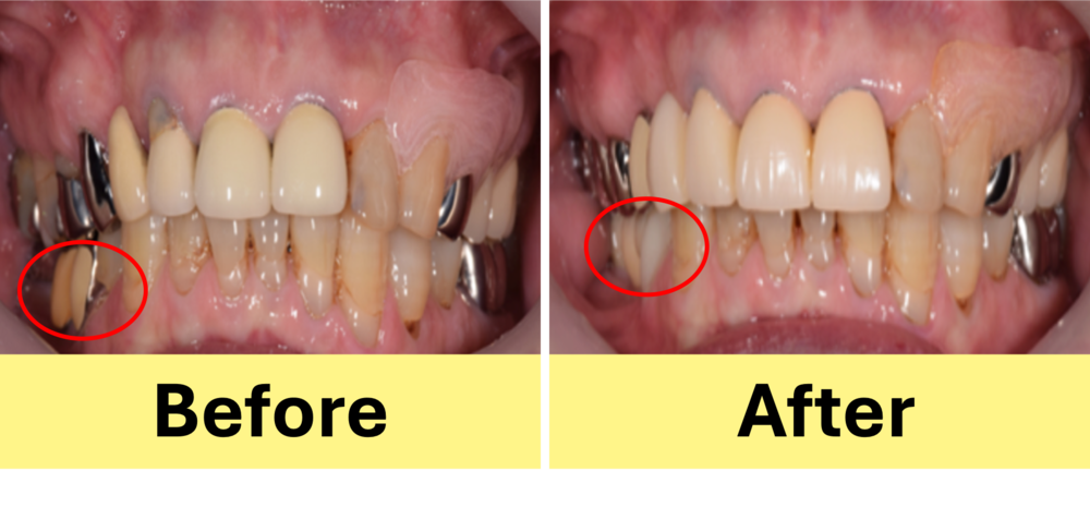 【症例】ブリッジが壊れた部位に対するインプラント治療で、奥歯でしっかり噛めるように