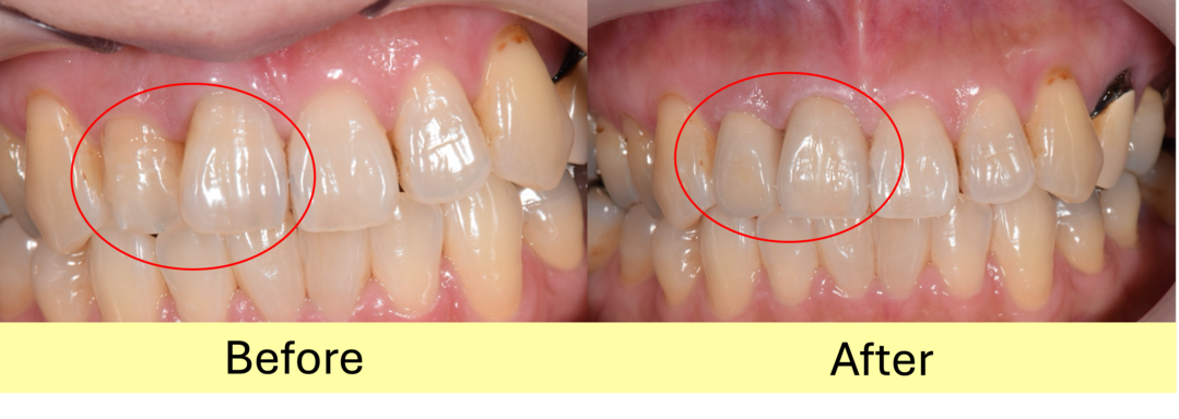 【症例】前歯の変色と歯の重なりをジルコニアセラミックにて修復