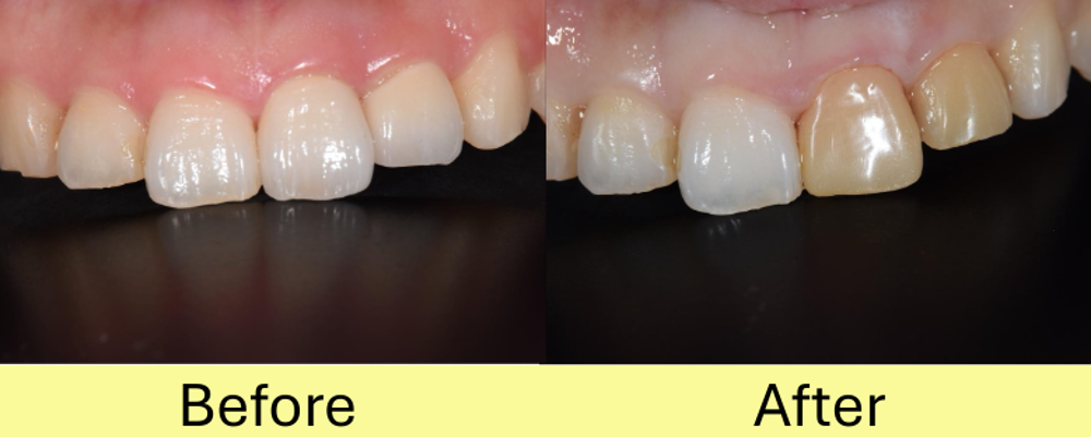 【症例】マウスピース矯正終了後に前歯の被せ物をジルコニアセラミックで審美治療