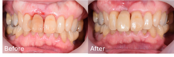 【症例】出血や動揺のある前歯の抜歯後インプラント治療で機能と見た目を回復