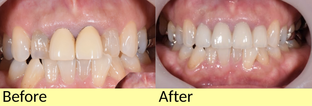【症例】劣化で変色した被せ物をジルコニアセラミックでやりかえ