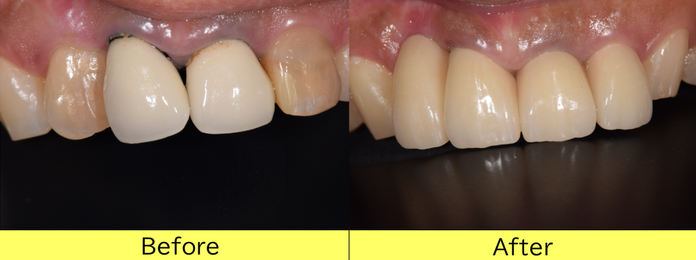 【症例】歯根破折から歯根吸収をした前歯に対するインプラントとジルコニアを用いた審美治療