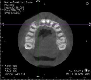 横浜市桜木町の歯医者「みらい歯科」症例｜【症例】歯根破折から歯根吸収をした前歯に対するインプラントとジルコニアを用いた審美治療｜治療前のCT画像①