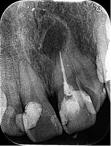 治療前レントゲン画像｜【症例】保険適応の被せ物を用いた前歯の治療｜横浜市桜木町の歯医者「みらい歯科」