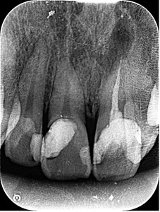 治療後レントゲン画像｜【症例】保険適応の被せ物を用いた前歯の治療｜横浜市桜木町の歯医者「みらい歯科」